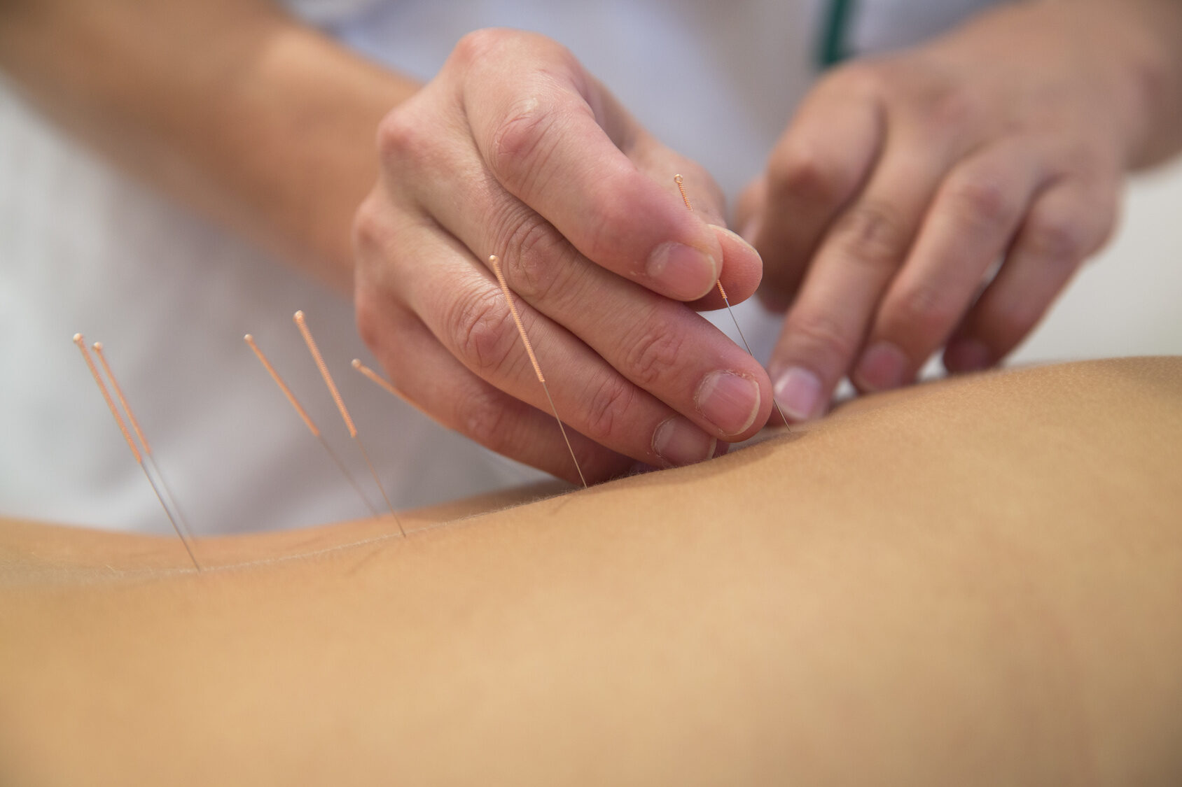 treatment-by-acupuncture